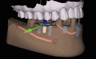 Implant Placement Using The X-Guide at Turella Oral Surgery in Port Angeles, WA Implant Placement Using The X-Guide at Turella Oral Surgery in Port Angeles, WA
